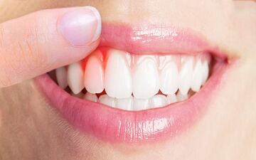 راه‌های مقابله با عفونت لثه