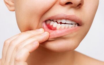 شیوع بیماری‌ های لثه در میانسالی|  راهکار ها و نحوه پیشگیری

