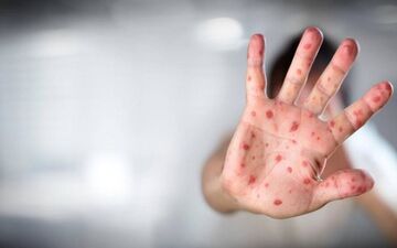 هر آنچه که باید درباره بیماری آبله بدانید
