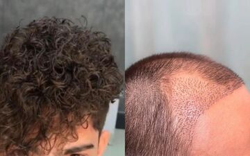 دلایل فر شدن مو بعد از کاشت و روش‌های کنترل آن