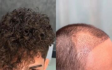 دلایل فر شدن مو بعد از کاشت و روش‌های کنترل آن