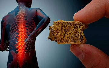 چگونه با تغذیه مناسب از پوکی استخوان جلوگیری کنیم؟