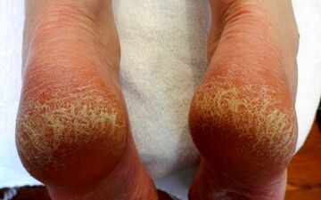دلایل ایجاد ترک پاشنه‌ی پا