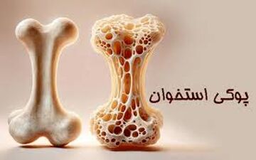 وقتی استخوان‌ها پوک می‌شوند