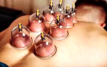به هیچ عنوان در این مواقع حجامت نکنید!