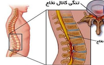 علائم تنگی کانال نخاعی چیست؟
