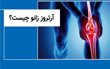 آرتروز زانو شایع ترین بیماری مفصلی را جدی بگیرید