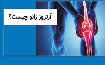 آرتروز زانو شایع ترین بیماری مفصلی را جدی بگیرید