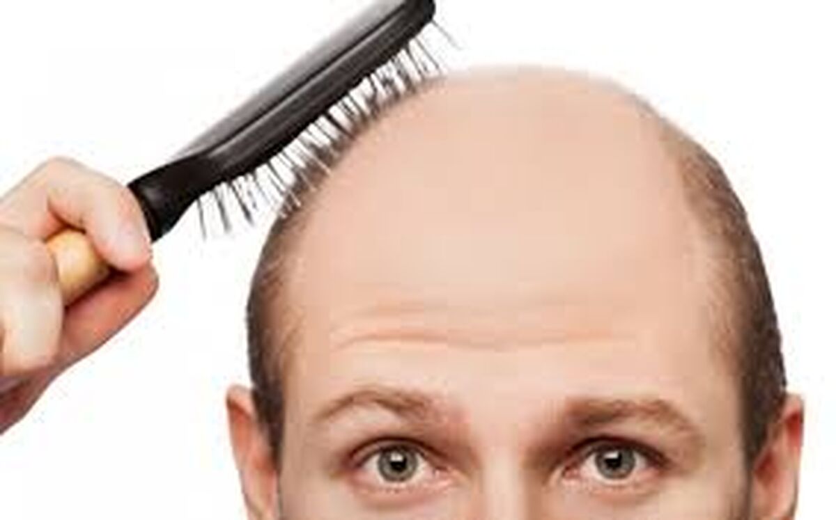 یک داروی قدیمی با قیمتی بسیار ارزان برای رویش موهای جدید