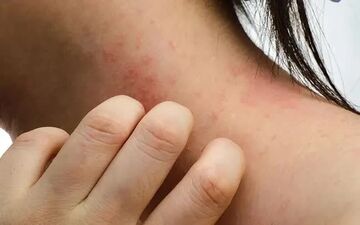 چرا پوستمان دچار بثورات می‌شود؟ از نیش حشرات تا بیماری‌های خودایمنی