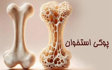 پوکی استخوان؛ تشخیص و درمان به‌ موقع
