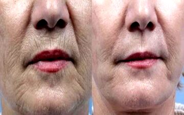 چگونه چین و چروک‌های دور لب را از بین ببریم؟