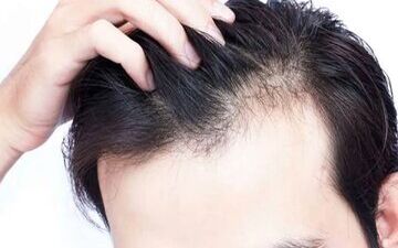 با کمبود این ویتامین‌ها دچار ریزش مو می‌شوید

