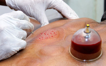 عواقب حجامت خودسرانه در فصل بهار/ افرادی که باید دور این روش درمانی را خط قرمز بکشند!