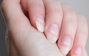 چه بیماری هایی از ظاهر ناخن‌ها مشخص است؟

