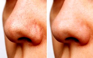 جوش سرسیاه داری؟ اینجا رو بخون تا یاد بگیری چطوری از شرش خلاص شی!