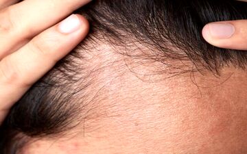 4 تکنیک ساده برای جلوگیری از ریزش مو