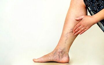 علائم واریس پا در زنان چیست؟

