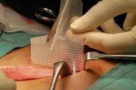 یک عارضه مهم بعد از جراحی فتق؛ علائم عفونت مش را بشناسید