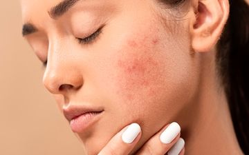 آیا جوش‌ صورت واگیردار است؟