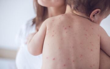در صورت ابتلا به آبله مرغان چند روز در قرنطینه باشیم؟