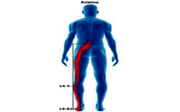 تاثیر پیاز بر درمان سیاتیک/ رگ سیاتیک‌تان گرفت سه سوته خوبش کن!
