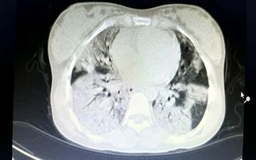 نجات جان مادر باردار با 80 درصد درگیری ریه در زنجان/ بیمار واکسن کرونا تزریق نکرده است