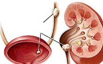 چگونه از سنگ کلیه پیشگیری کنیم؟ 