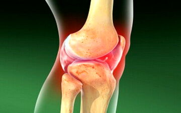 آرتریت سپتیک چیست و چه علائمی دارد؟
