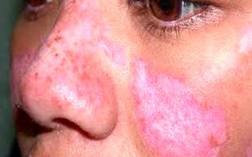 اختلال در بخش های مختلف بدن با بیماری لوپوس