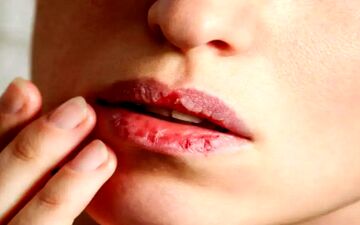 علت ترک در اطراف دهان و لب‌های پوسته پوسته چیست؟
