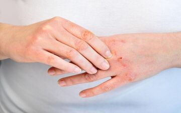 تغذیه بر اگزما اثر دارد؟

