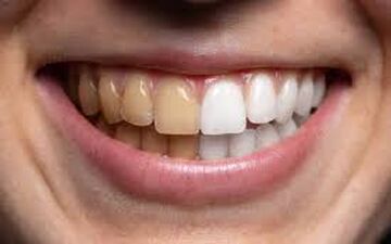 جرم‌گیری دندان چیست و چرا اهمیت دارد؟
