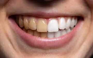 جرم‌گیری دندان چیست و چرا اهمیت دارد؟