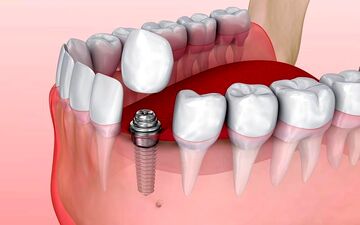 قیمت ایمپلنت با بیمه در مرکز ایمپلنت آیریک چقدر است ؟
