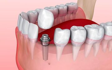قیمت ایمپلنت با بیمه در مرکز ایمپلنت آیریک چقدر است ؟