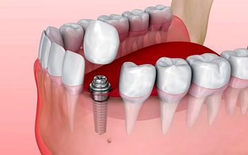 قیمت ایمپلنت با بیمه در مرکز ایمپلنت آیریک چقدر است ؟
