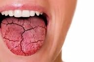 ارتباط بین تیروئید و خشکی دهان