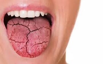 ارتباط بین تیروئید و خشکی دهان
