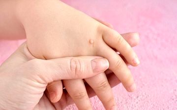 از علت تا درمان زگیل‌های دوران کودکی