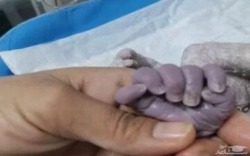 جان مادر باردار در بیمارستان رازی ایلام نجات یافت