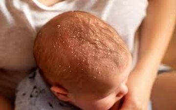با پوسته های سر نوزاد چکار کنیم؟