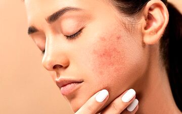 خودارضایی باعث آکنه می شود؟