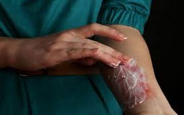 چند توصیه در مواجهه با سوختگی های سطحی!
