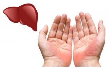 تغییرات کف دست نشانه چه بیماری است؟

