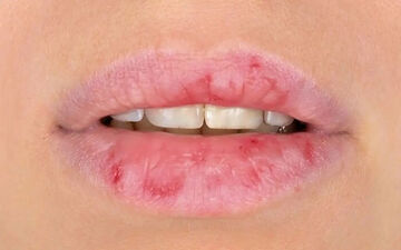 خشکی دهان و زبان؛ چه زمانی زنگ خطر بیماری به صدا درمی‌آید؟