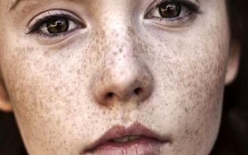  چرا روی پوست لکه می‌افتد؟