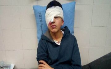 نوجوان فلسطینی به ضرب گلوله صهیونیست‌ها یک چشم خود را از دست داد