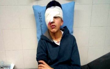 نوجوان فلسطینی به ضرب گلوله صهیونیست‌ها یک چشم خود را از دست داد