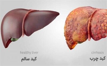  دستورات طب سنتی برای درمان "کبد چرب" 